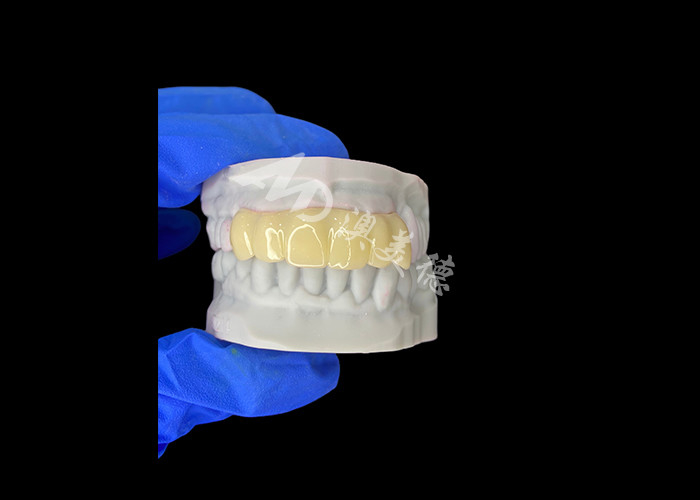 Jembatan sementara berongga 3D yang dicetak untuk restorasi pra-implantasi
