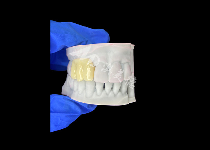 Jembatan sementara berongga 3D yang dicetak untuk restorasi pra-implantasi