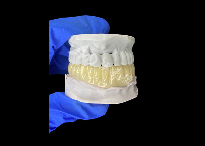 Jembatan sementara berongga 3D yang dicetak untuk restorasi pra-implantasi