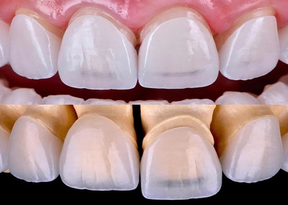 Harga yang bagus EMAX veneer gigi yang tahan lama yang terbuat dari semua bahan sirkonium keramik on line
