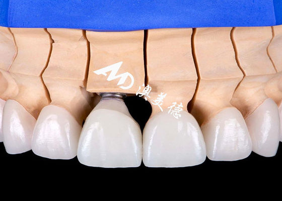 Harga yang bagus Biocompatible Titanium Alloy Base Dental Implant Crown Bridge dengan penampilan alami on line