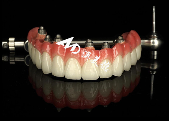 Harga yang bagus Dental Implantasi disokong gigi palsu Crown Bridge Untuk pemeliharaan gigi hilang on line