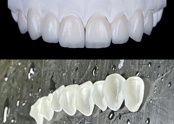 Harga yang bagus IPS emax Pencet Porselen Veneers Mencapai Senyum Alami dan Cerah on line