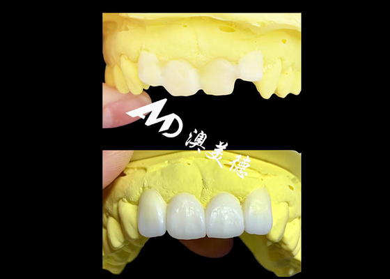 Harga yang bagus Custom Translucent Zirconia dental crowns dibuat oleh AMD Dental Lab on line