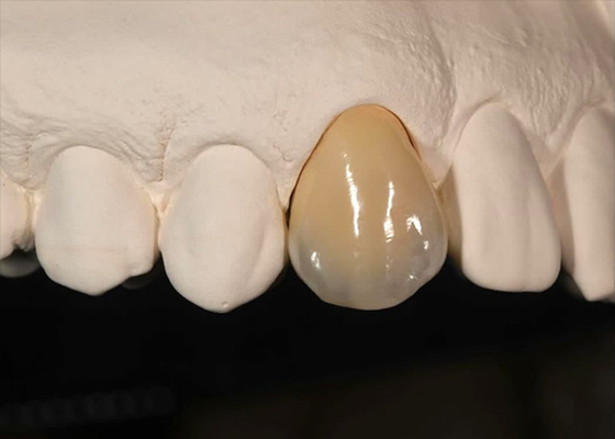 Harga yang bagus Ketahanan pewarnaan Mahkota Zirconia padat untuk gigi depan gigi belakang on line