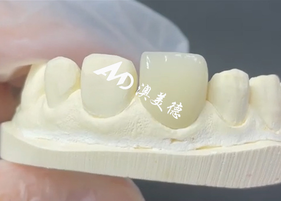Harga yang bagus EMAX Veneer yang awet dan estetis Solusi yang Sempurna untuk Restorasi Porselen on line