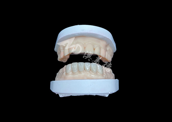 Harga yang bagus IPS Emax Veneers Restorasi Penampilan Alami Untuk Senyum Estetika on line