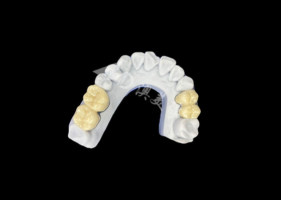 Harga yang bagus Zirconia PFZ Porselin Dental Crown Dari Profesional China Dental Lab on line