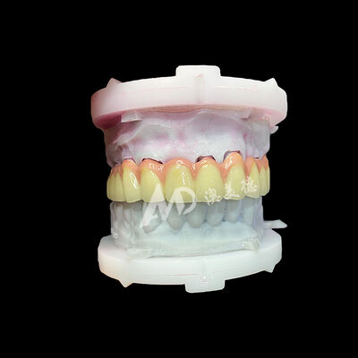 Harga yang bagus Puri Titanium Keramik Mahkota dan Jembatan awet Ringan Restorasi Estetika on line